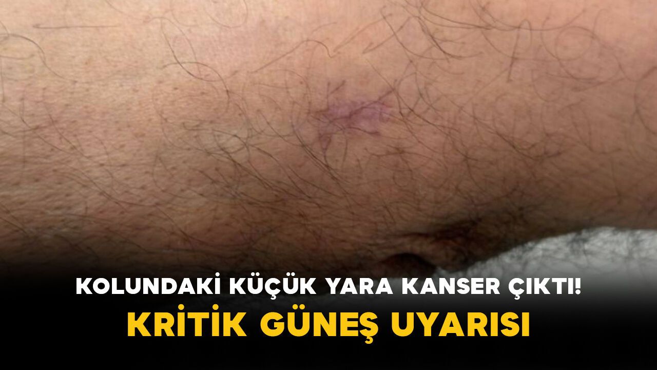 Kolundaki küçük yara kanser çıktı! Kritik güneş uyarısı