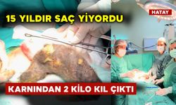 15 Yıldır Saç Yiyen Genç Kızın Karnından Bakın Ne Çıktı