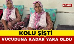 Kolu şişti, vücuduna kadar yara oldu: 4 çocuk annesinin zorlu yaşamı