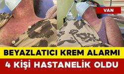Beyazlatıcı Krem Alarmı: 4 Kişi Hastanelik Oldu
