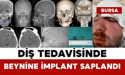 Diş Tedavisinde Beynine İmplant Saplandı