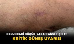 Kolundaki küçük yara kanser çıktı! Kritik güneş uyarısı