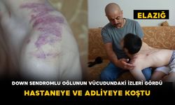 Down Sendromlu Oğlunun Vücudundaki İzleri Gördü: Hastaneye ve Adliyeye Koştu