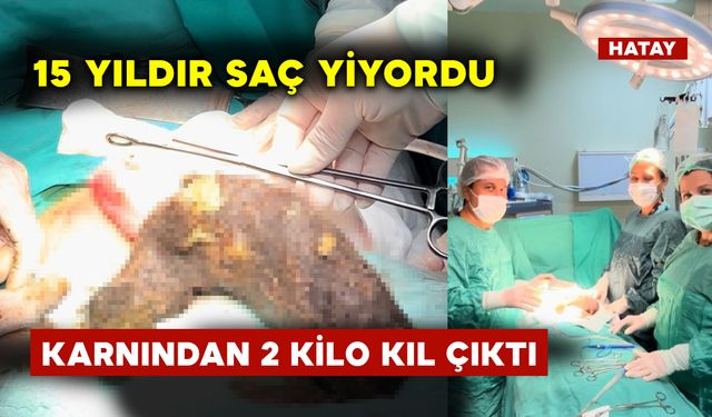 15 Yıldır Saç Yiyen Genç Kızın Karnından Bakın Ne Çıktı