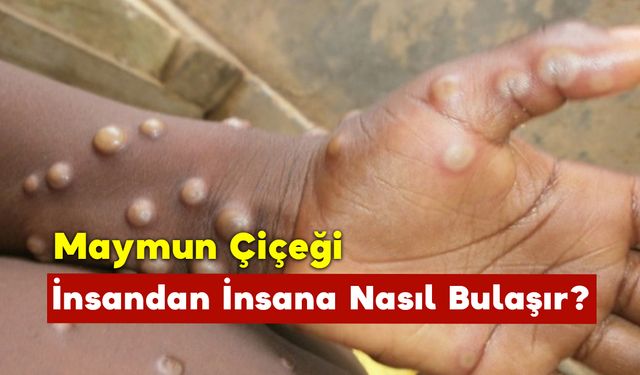 Maymun Çiçeği İnsandan İnsana Nasıl Bulaşır?