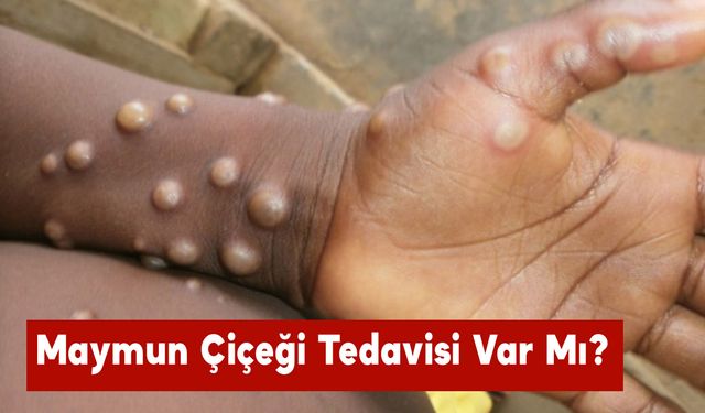 Maymun Çiçeği Tedavisi Var Mı?