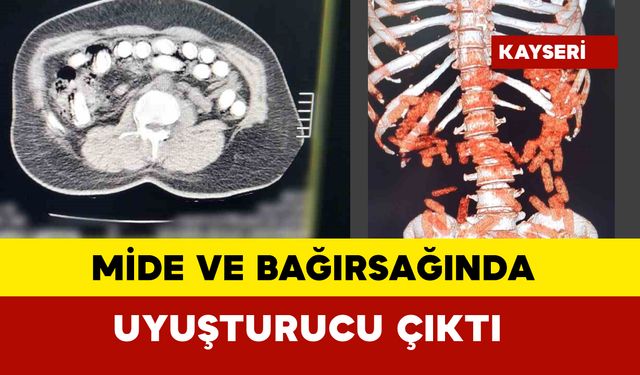 Mide ve bağırsağından çıkan uyuşturucu pes dedirtti