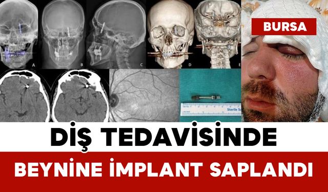 Diş Tedavisinde Beynine İmplant Saplandı