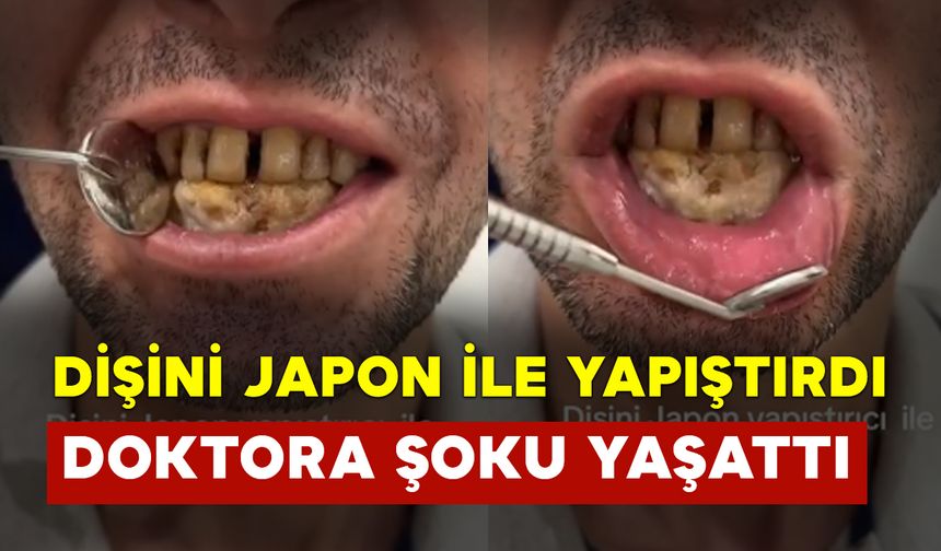 Dişini Japon Yapıştırıcısıyla Yapıştıran Adam Doktoru Şoku Yaşattı