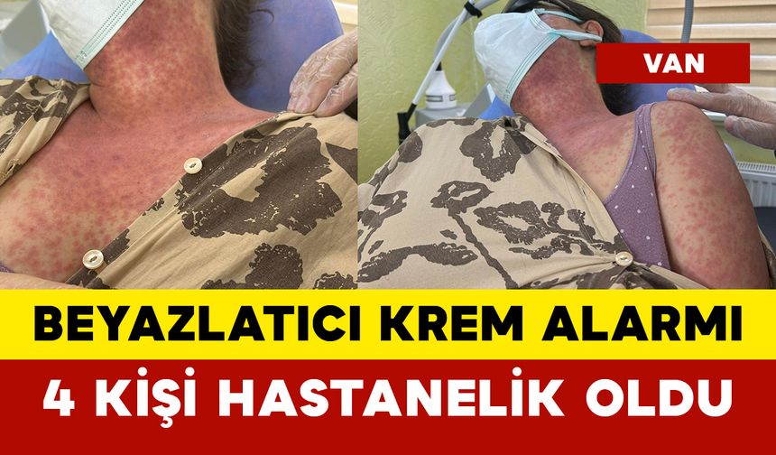 Beyazlatıcı Krem Alarmı: 4 Kişi Hastanelik Oldu