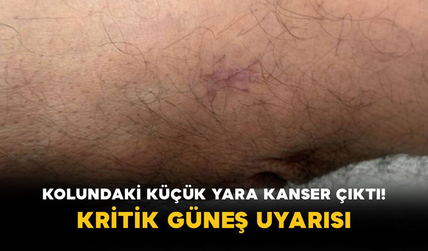 Kolundaki küçük yara kanser çıktı! Kritik güneş uyarısı