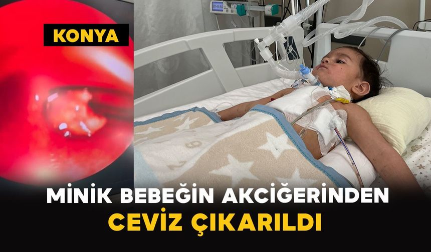 Konya’da 1 yaşındaki bebeğin akciğerinden ceviz çıkarıldı