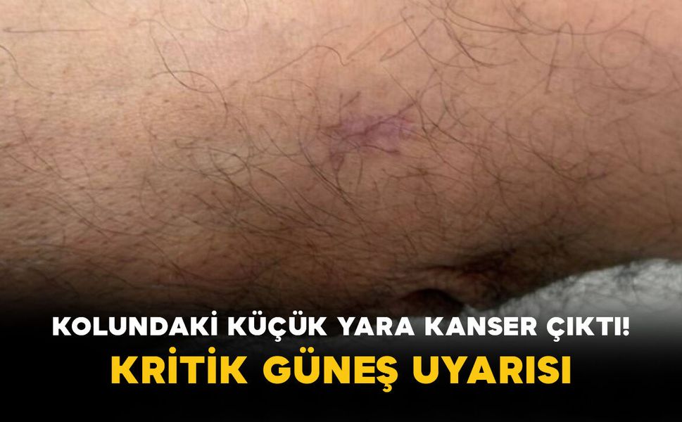 Kolundaki küçük yara kanser çıktı! Kritik güneş uyarısı