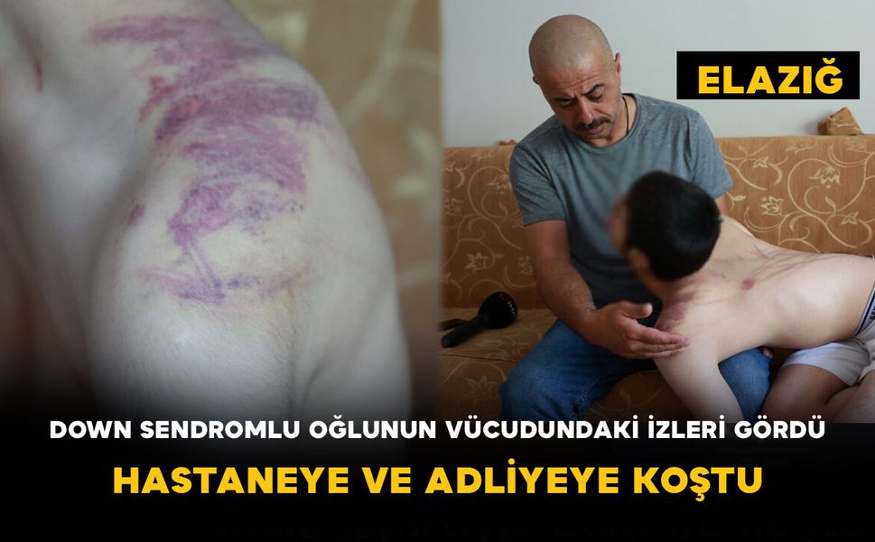 Down Sendromlu Oğlunun Vücudundaki İzleri Gördü: Hastaneye ve Adliyeye Koştu
