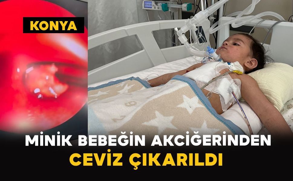Konya’da 1 yaşındaki bebeğin akciğerinden ceviz çıkarıldı