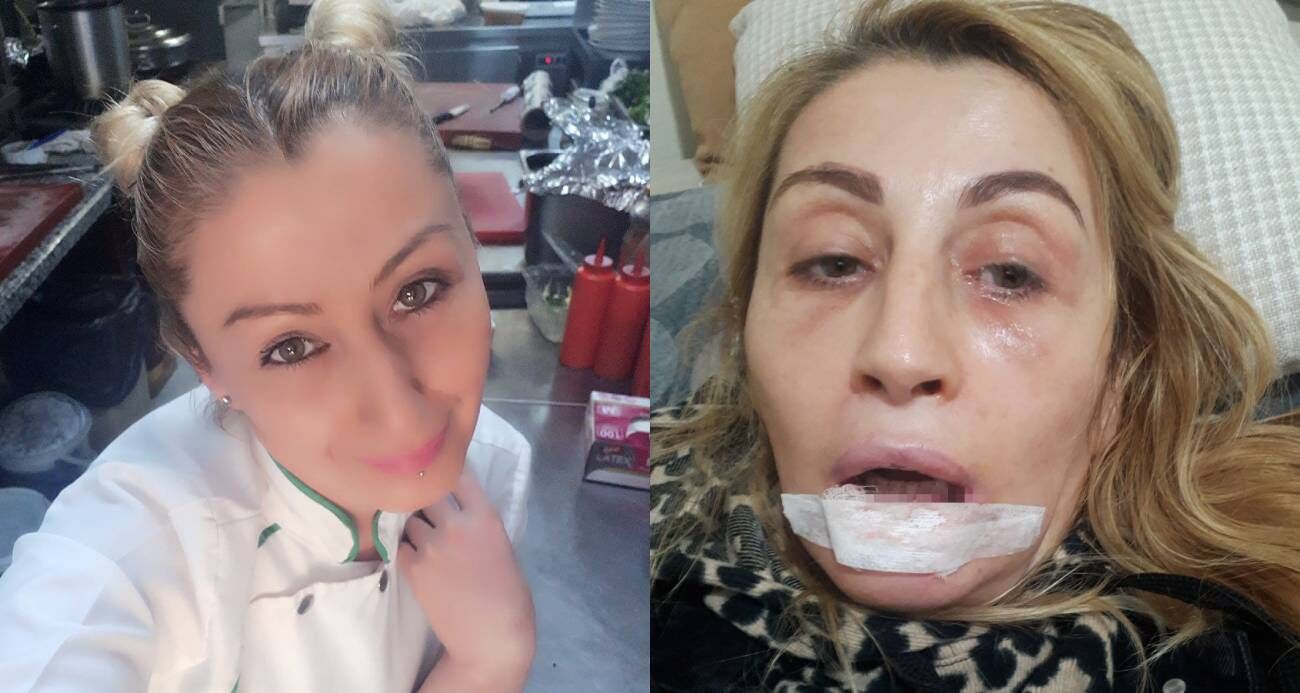Estetik Islem Sonrasi Dudagi Curudu (2)